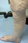 varicose vein treatment