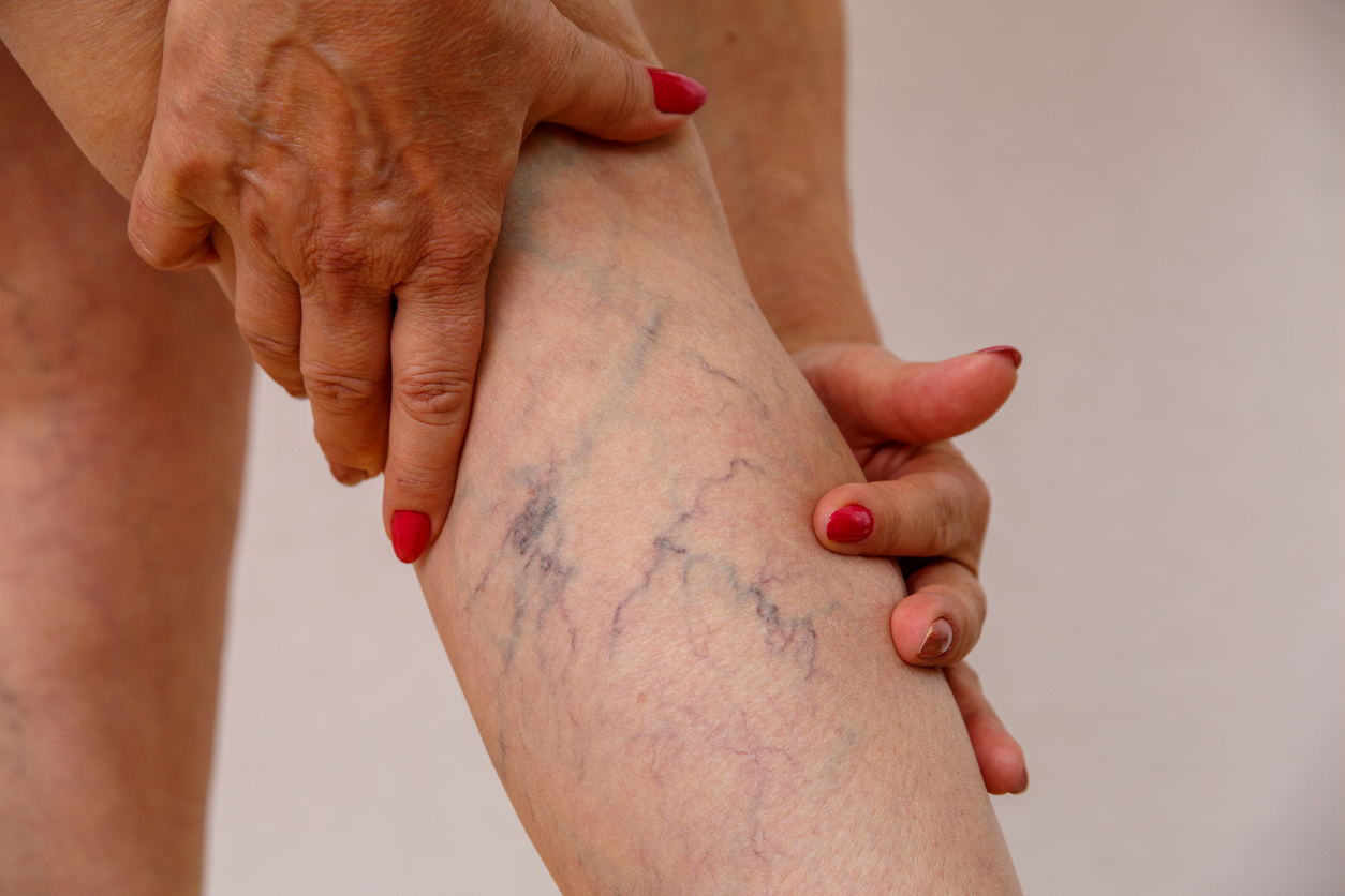 elderly woman with varicose veins on calf