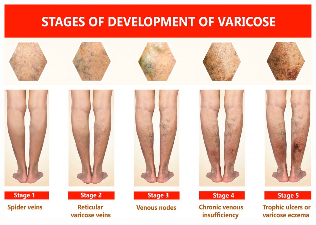 What Is Venous Ulcer Disease