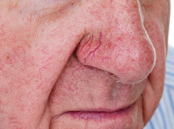 get rid of spider veins on your nose