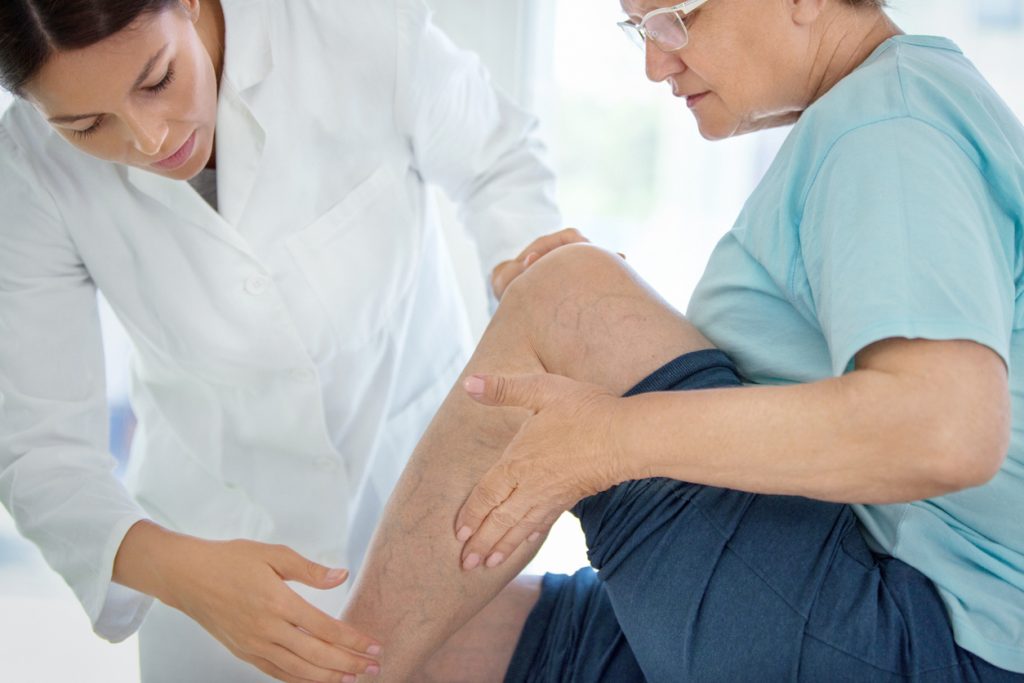 senior woman with visible varicose veins at medical appointment