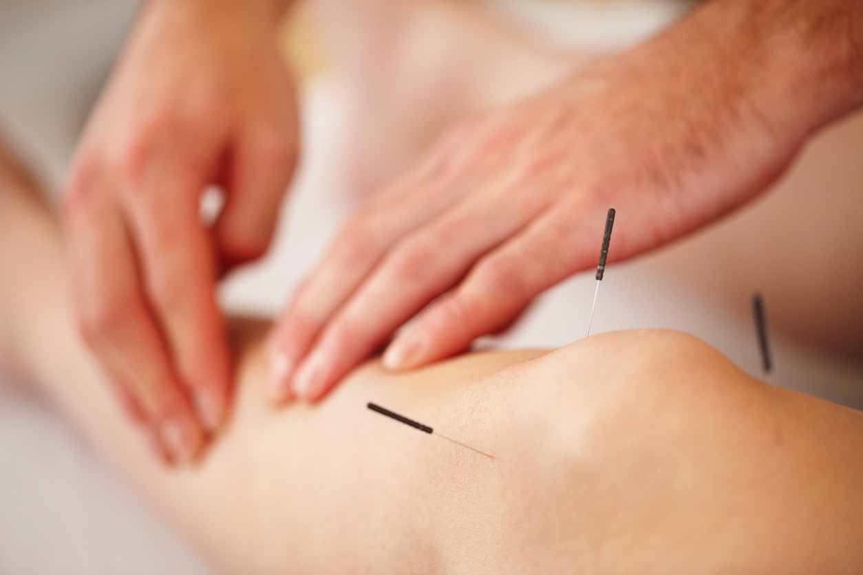 woman getting acupuncture treatment on knee
