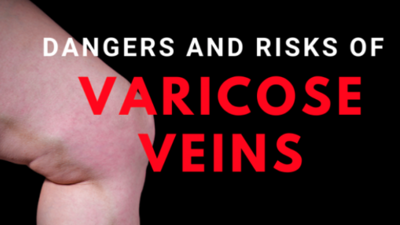Dangers of Varicose Veins
