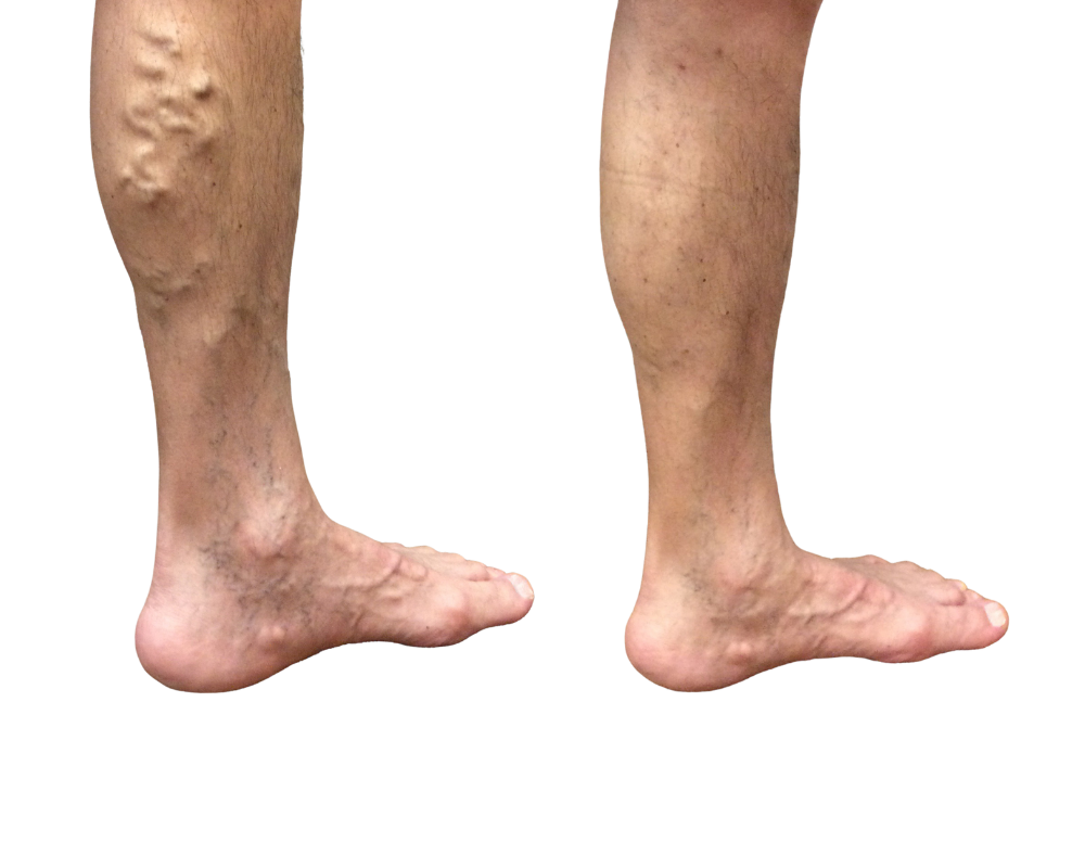 Vein & Vascular Treatment