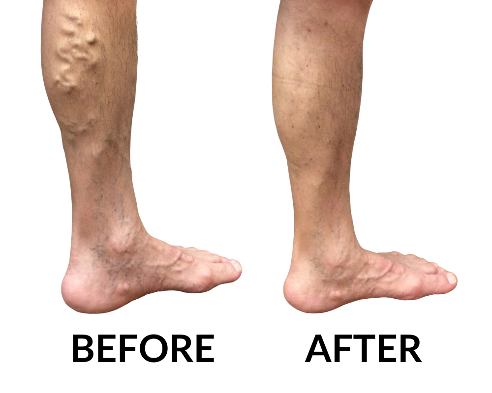 Best Deptford Varicose Vein Specialist