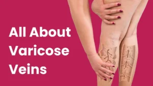 All about varicose veins
