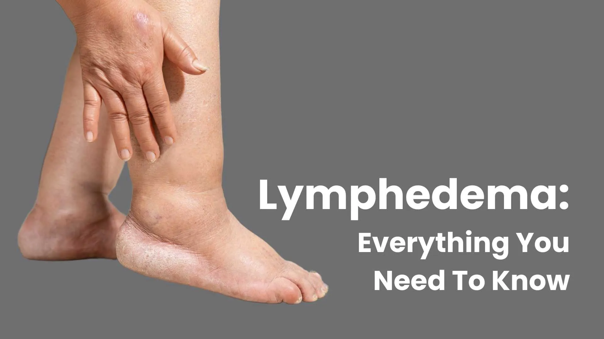 Lymphedema: Everything You Need To Know