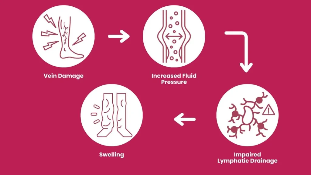Lymphedema Treatment 