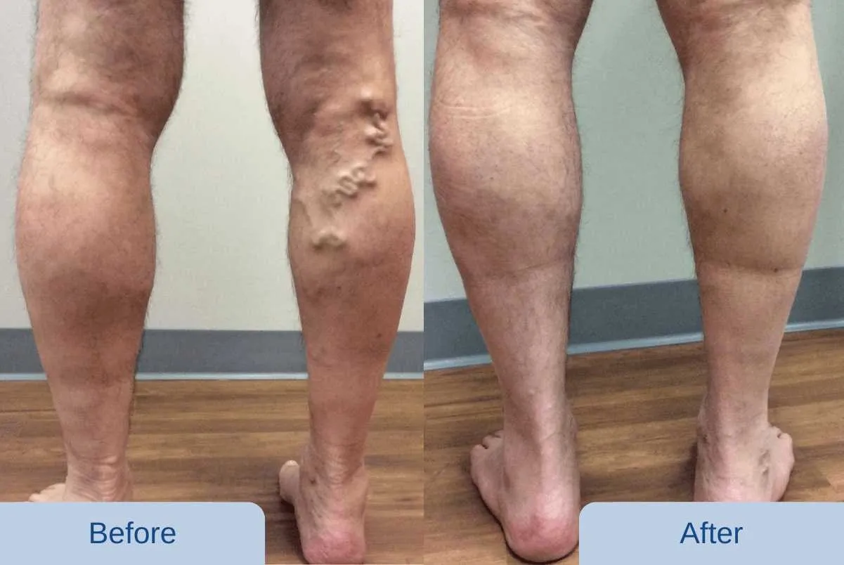 before and after vein doctor