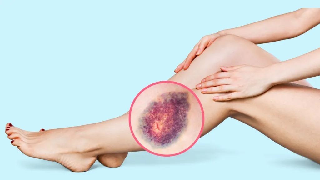 Varicose veins