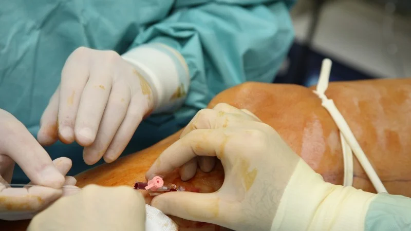 Microphlebectomy