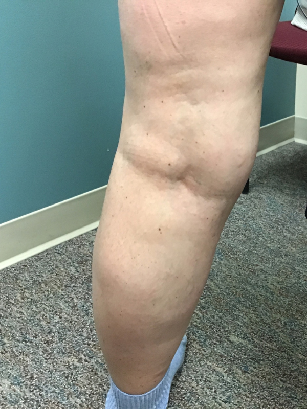 evra-closure-after-63yr-female