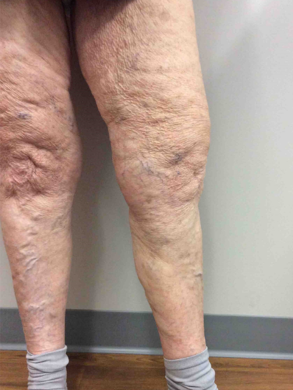 evra-closure-after-87yr-female