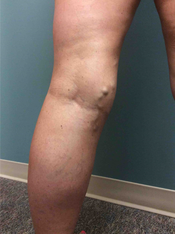 evra-closure-before-63yr-female