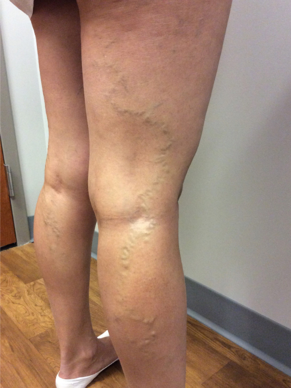 microphlebectomy-before-42yr-female