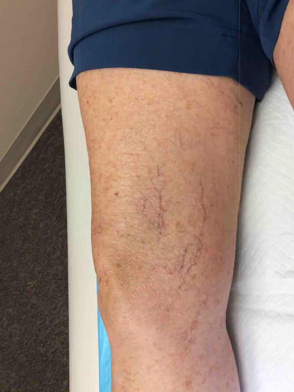 sclerotherapy-after-64yr-female