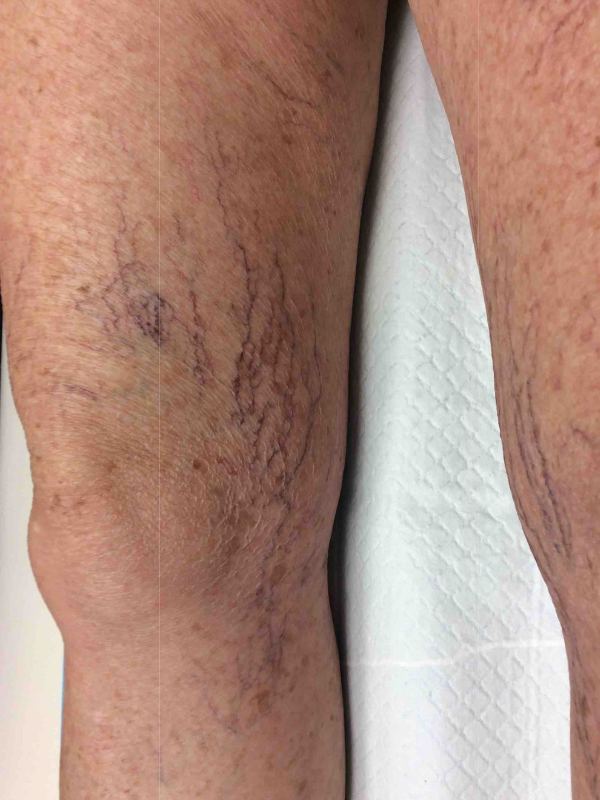 sclerotherapy-before-64yr-female